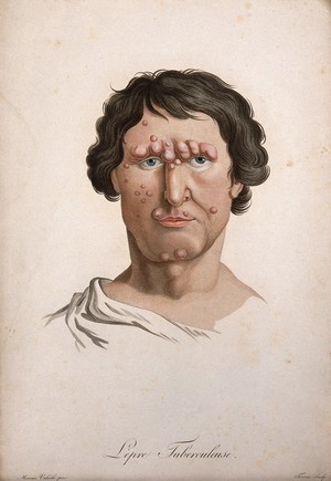 view A head of a man with a skin disease on his face. Coloured stipple engraving by S. Tresca after Moreau-Valvile, c. 1806.