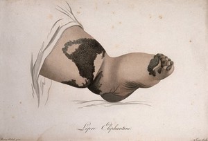 view A swollen foot and ankle with a skin disease. Coloured stipple engraving by S. Tresca after Moreau-Valvile, c. 1806.