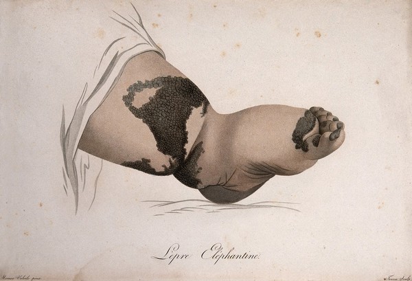 A swollen foot and ankle with a skin disease. Coloured stipple engraving by S. Tresca after Moreau-Valvile, c. 1806.