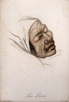 A head of a man with a skin disease on his face. Coloured stipple engraving by S. Tresca after Moreau-Valvile, c. 1806.