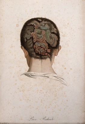 A head of a man with a skin disease on his scalp; back view. Coloured stipple engraving by S. Tresca after Moreau-Valvile, c. 1806.