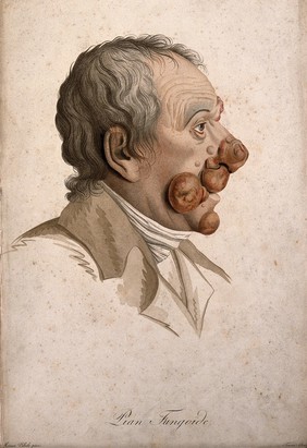 A head of a man with a skin disease on his face. Coloured stipple engraving by S. Tresca after Moreau-Valvile, c. 1806.