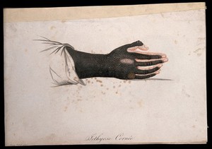 view A hand and forearm with a skin disease. Coloured stipple engraving by S. Tresca after Moreau-Valvile, c. 1806.