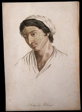A woman with a skin disease on her face and neck. Coloured stipple engraving by S. Tresca after Moreau-Valvile, c. 1806.