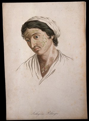 view A woman with a skin disease on her face and neck. Coloured stipple engraving by S. Tresca after Moreau-Valvile, c. 1806.