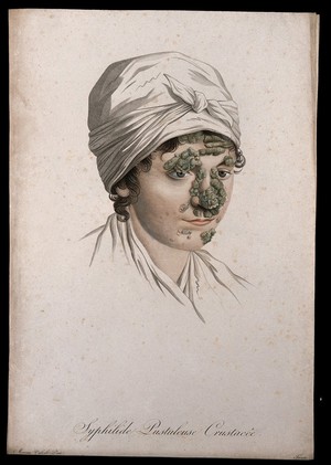 view A woman with a skin disease on her face. Coloured stipple engraving by S. Tresca after Moreau-Valvile, c. 1806.