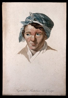 A woman with a skin disease on her face. Coloured stipple engraving by S. Tresca after Moreau-Valvile, c. 1806.