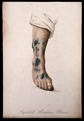 A lower leg and foot with a skin disease. Coloured stipple engraving by S. Tresca after Moreau-Valvile, c. 1806.