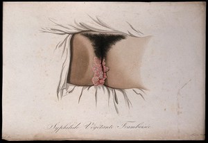 view Female genitalia with a skin disease. Coloured stipple engraving by S. Tresca after Moreau-Valvile, c. 1806.