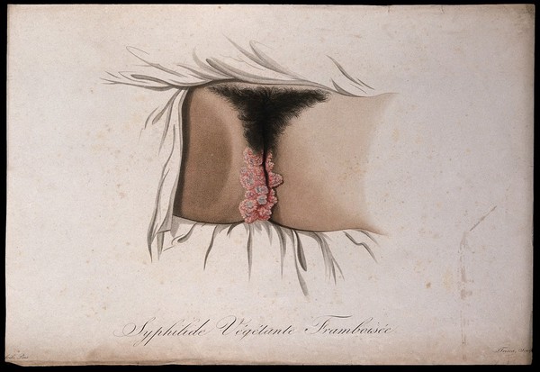 Female genitalia with a skin disease. Coloured stipple engraving by S. Tresca after Moreau-Valvile, c. 1806.