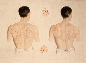 view A man with a skin disease on his back, and another; and two details of skin disease. Coloured aquatint by Bennett after J. Harrison, c. 1820.
