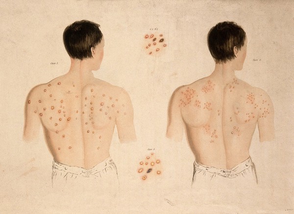 A man with a skin disease on his back, and another; and two details of skin disease. Coloured aquatint by Bennett after J. Harrison, c. 1820.