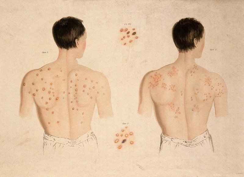 A man with a skin disease on his back, and another; and two details of skin disease. Coloured aquatint by Bennett after J. Harrison, c. 1820., c.1820, by John Harrison