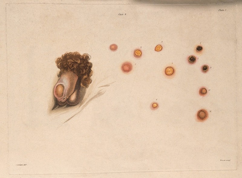 Male genitalia with a skin disease; and varieties of sores which appeared on other parts of the man's body. Coloured aquatint by Bennett after J. Harrison, c. 1820., c.1820, by John Harrison
