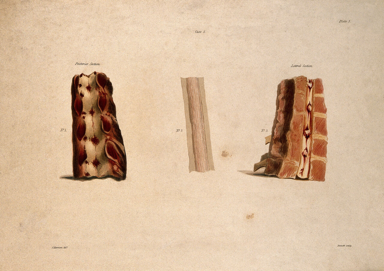Three sections of vertebrae. Coloured aquatint by Bennett after J. Harrison, c. 1820., c.1820, by John Harrison