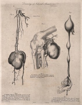 Three examples of aneurisms with surrounding arteries, lettered for key. Etching by Archibald after J. Bell, c. 1810 (?).