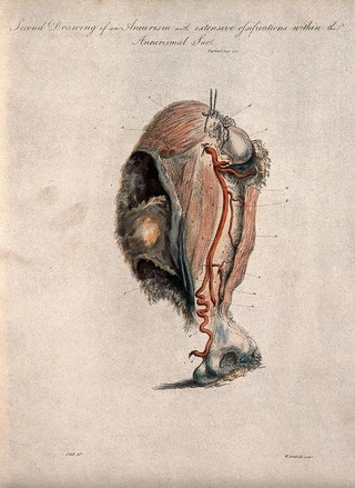 An aneurism, numbered for key. Coloured stipple etching by W. Archibald after J. Bell, c. 1810 (?).