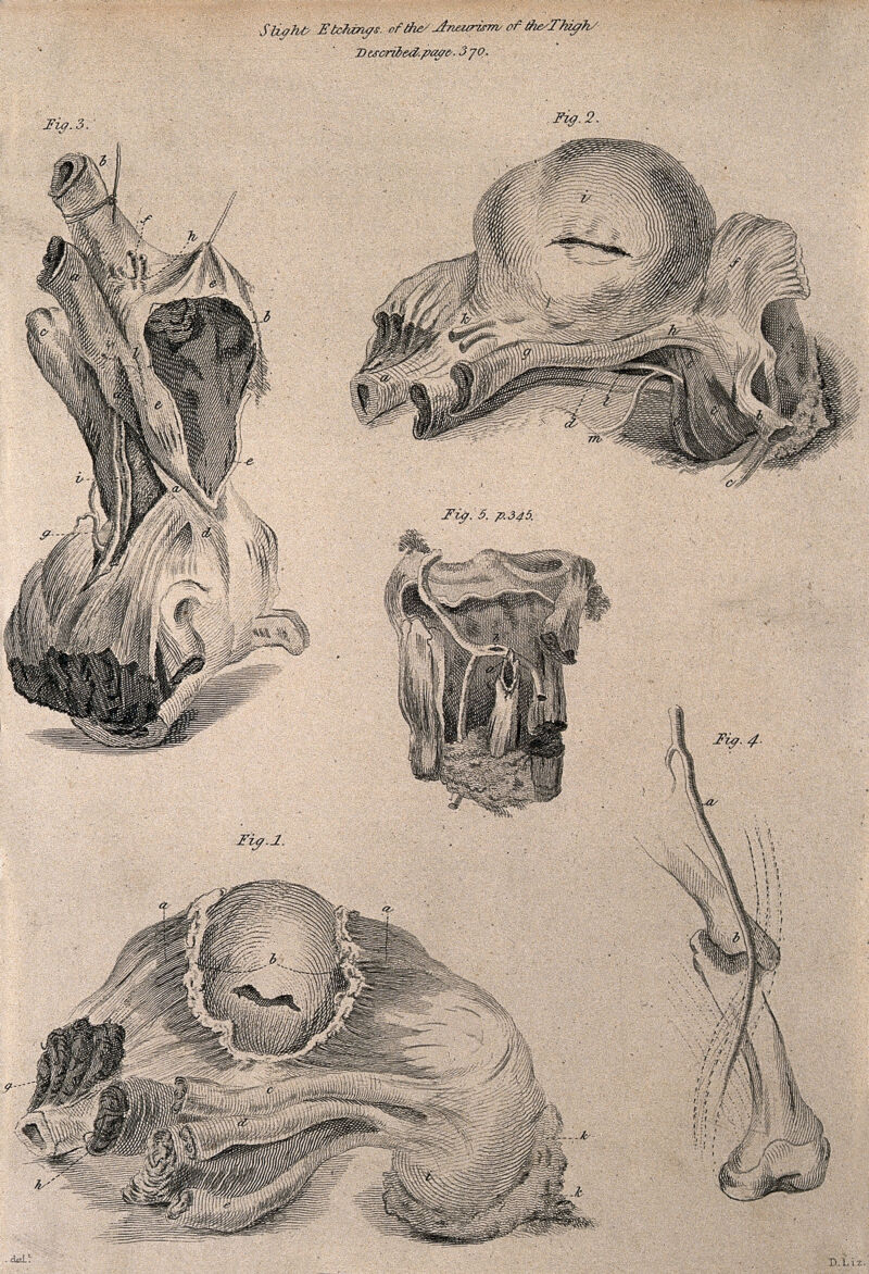 Five examples of aneurisms of the thigh, lettered for key. Etching by D. Lizars, c. 1810 (?)., by Daniel Lizars Sr.