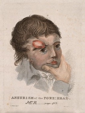 A man with an aneurism on his forehead. Coloured stipple etching by D. Lizars after J. Bell, c. 1810 (?).