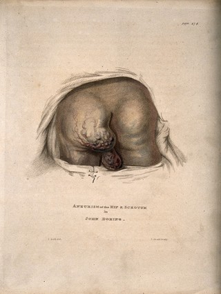 A man's bottom with an aneurism on the buttock and scrotum. Coloured stipple etching by J. Grant after J. Bell, ca. 1815.