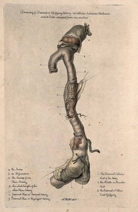 A diseased artery. Coloured stipple etching after J. Bell, c. 1810 (?).