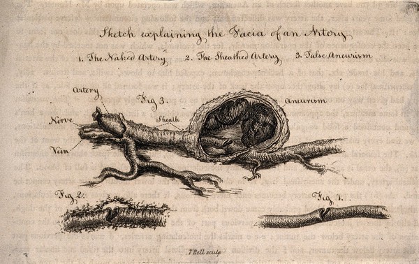 Three sections of a dissected artery, numbered for key. Etching by I. Bell, c. 1815 (?).