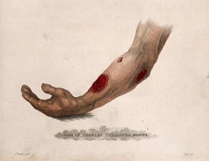 view A forearm with three open wounds. Coloured stipple etching after J. Bell, c. 1815 (?).