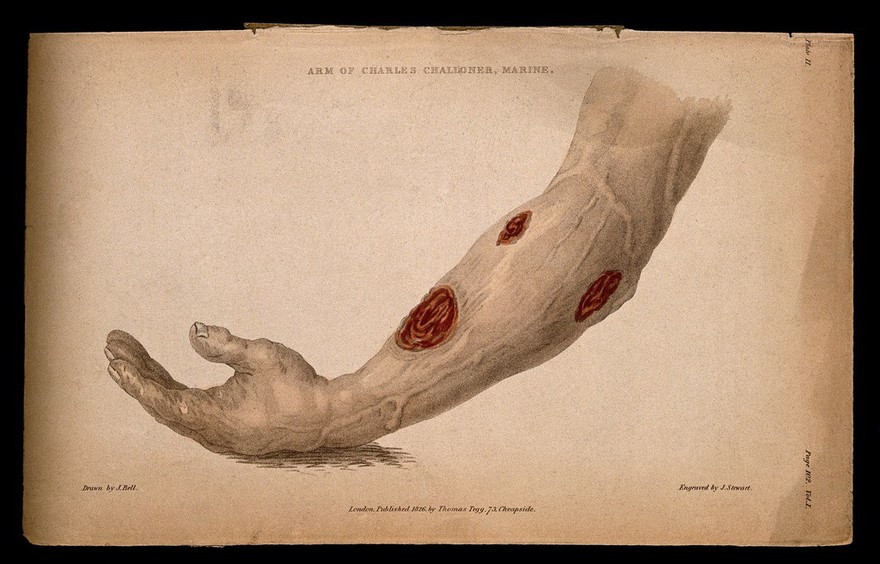 A forearm with three open wounds. Coloured stipple etching by J. Stewart after J. Bell, c. 1826.