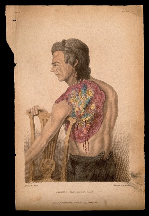 A man with a wounded back and shoulder leaning against a chair back. Coloured stipple etching by J. Stewart after J. Bell, c. 1826.