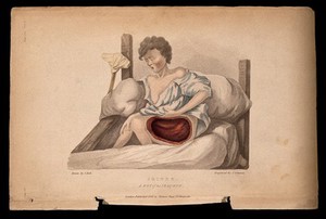 view A boy with a wounded thigh seated on a bed; a crutch to his right. Coloured stipple etching by J. Stewart after J. Bell, c. 1826.