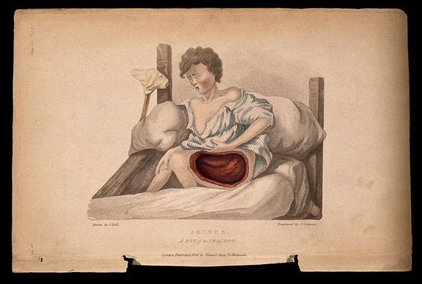 A boy with a wounded thigh seated on a bed; a crutch to his right. Coloured stipple etching by J. Stewart after J. Bell, c. 1826.