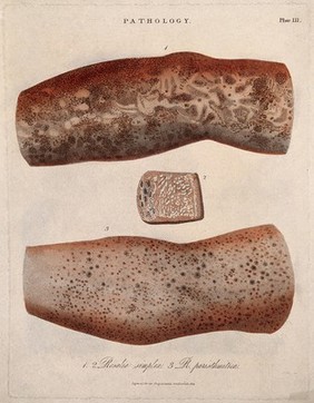 Two sections of limb with a skin disease; and a detail of a skin disease. Coloured stipple etching by J. Pass, c. 1822.