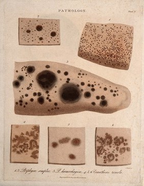 Six patches of skin showing types of skin disease. Coloured stipple etching by J. Pass, c. 1822.