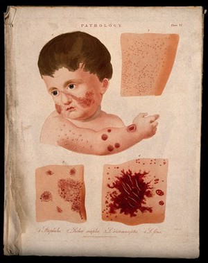 view Head and arm of a baby with a skin disease; and three patches of skin disease. Coloured stipple etching by J. Pass, c. 1822.