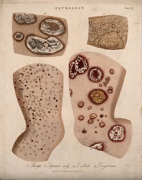 Four patches of skin showing types of skin disease. Coloured stipple etching by J. Pass, c. 1822.