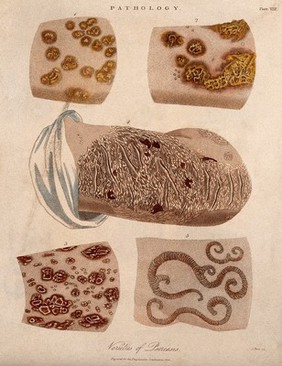 Five patches of skin showing types of skin disease. Coloured stipple etching by J. Pass, c. 1822.