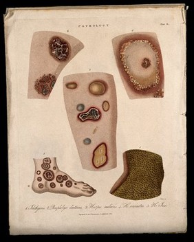 A foot with a skin disease; and four patches of skin showing types of skin disease. Coloured stipple etching by J. Pass, c. 1822.