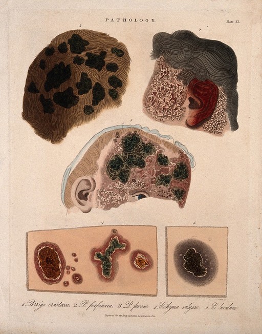 Three sections of a head with a skin disease; and two patches of skin showing types of skin disease. Coloured stipple etching by J. Pass, c. 1822.