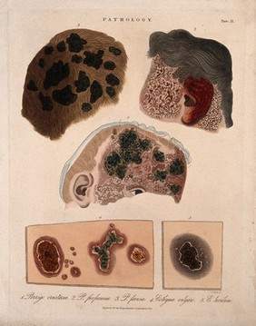 Three sections of a head with a skin disease; and two patches of skin showing types of skin disease. Coloured stipple etching by J. Pass, ca. 1822.