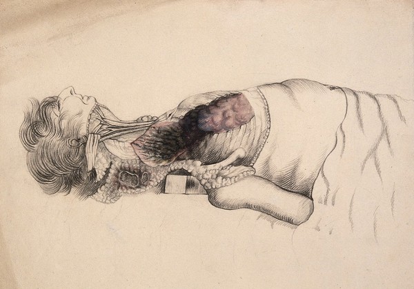 A reclining man, possibly on an autopsy table, with dissected neck and top of chest. Coloured drawing.