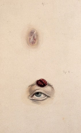 A section of a child's diseased forehead (detail); and a child's diseased eyebrow, numbered for key. Watercolour, 1829.