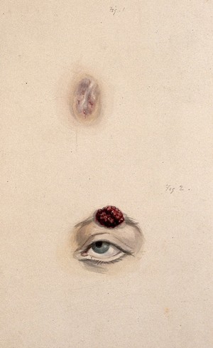 view A section of a child's diseased forehead (detail); and a child's diseased eyebrow, numbered for key. Watercolour, 1829.