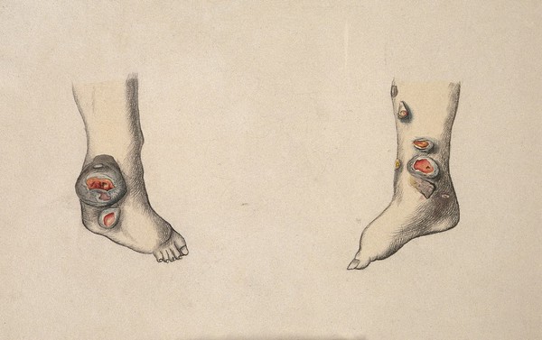 Two diseased feet. Coloured drawing.