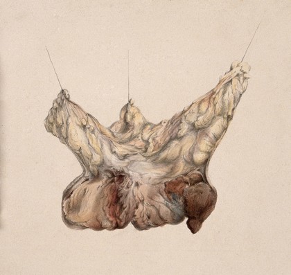 A diseased female breast. Watercolour.