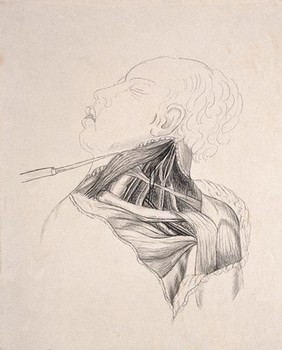 The dissected neck, chest and shoulder of a man: the skin being held back with a surgical instrument to reveal the muscles beneath. Drawing.