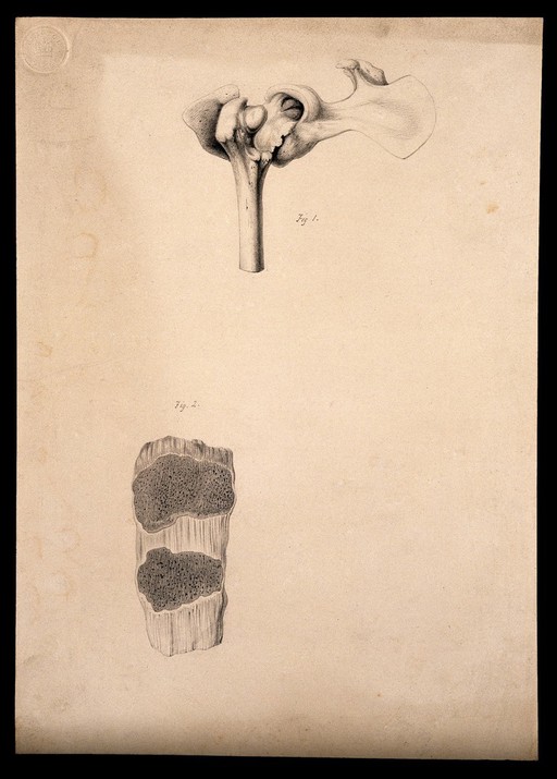 The dislocated thigh bone of a dog; and a fractured patella, numbered for key. Drawing.