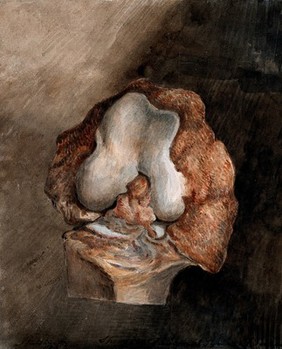 A diseased section of bone. Watercolour, 1822.