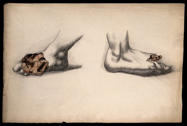 Two diseased feet. Coloured drawing.