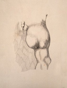 The genitals and right leg of a man, showing a deformity of the thigh. Drawing.