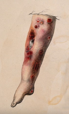 A diseased lower leg. Coloured drawing.